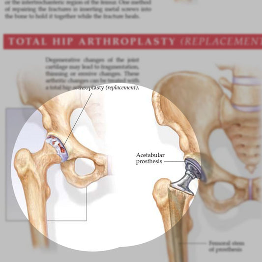 Anatomy and Injuries of the Hip (Laminated) – Physio supplies canada