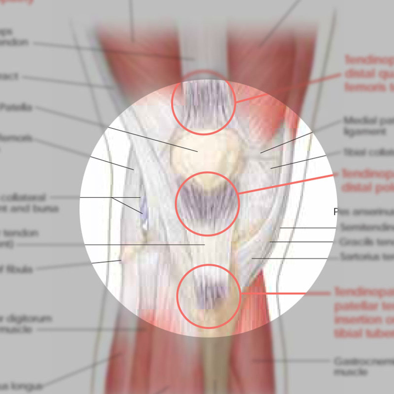 Athletic Injuries of the Knee ( Laminated) - physio supplies canada